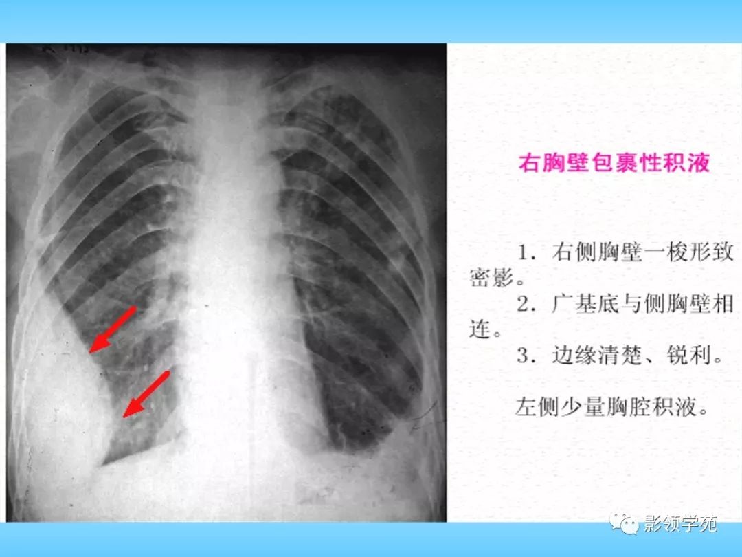 胸部正常影像学及基本病变