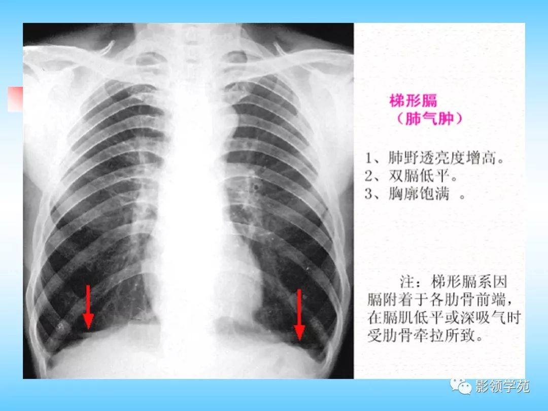 胸部正常影像学及基本病变