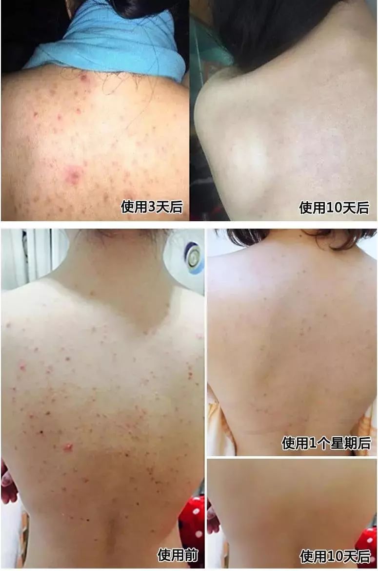 后背前胸起鸡皮肤(前胸鸡皮肤什么情况)