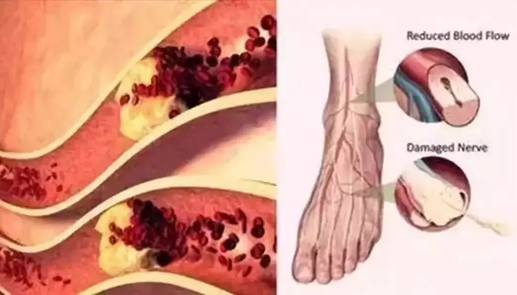 也有统计发现,在下肢动脉闭塞的人群中,有 60%可能合并有 心脑血管