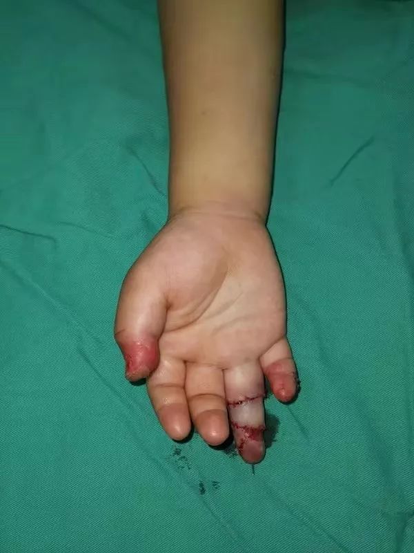 4岁男童手指被绞断医生显微镜下断指再植