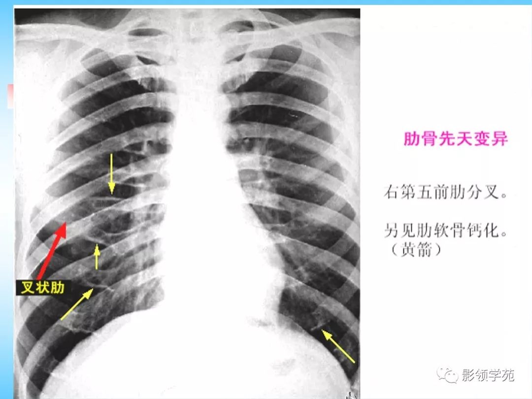 胸部正常影像学及基本病变