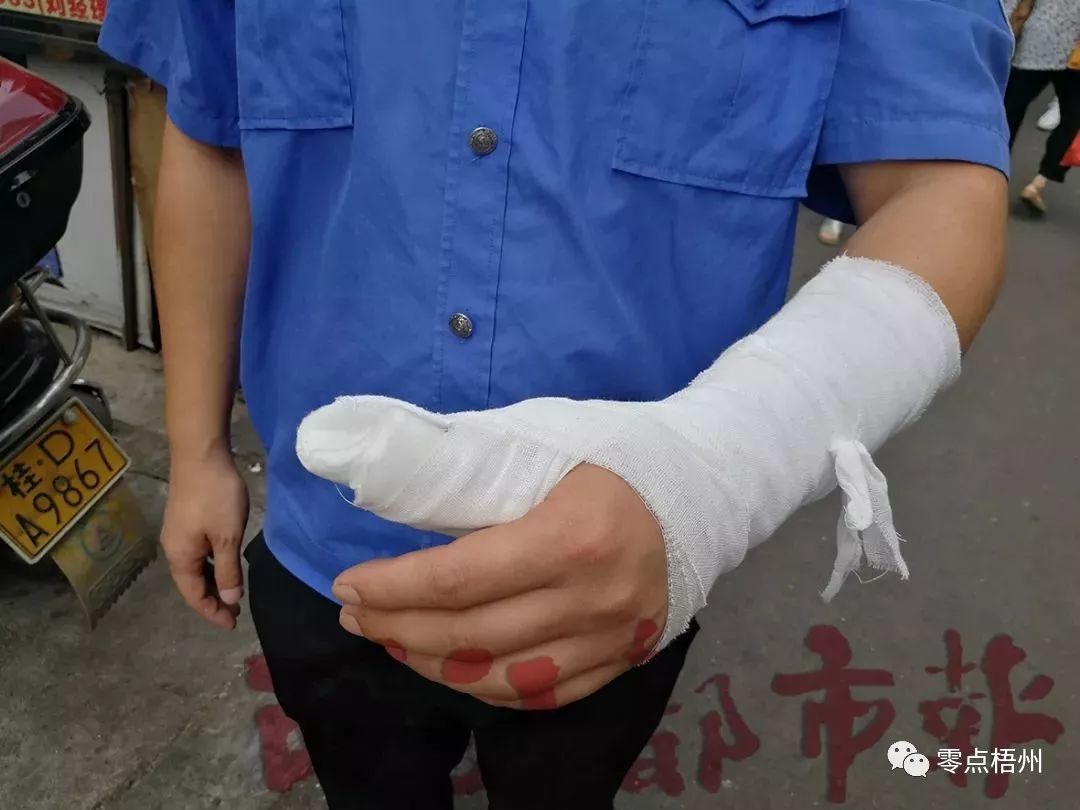 记者看到了正在巡查的小钟,只见他左手包扎着绷带,大拇指处已用石膏