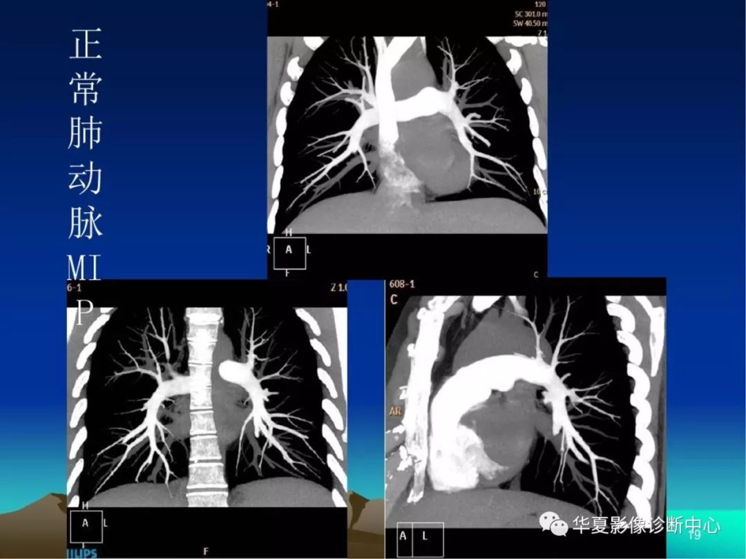 128层ct肺动脉造影诊断肺动脉栓塞