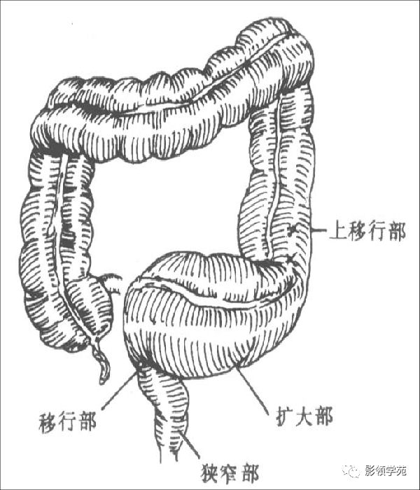 巨结肠肚子图片