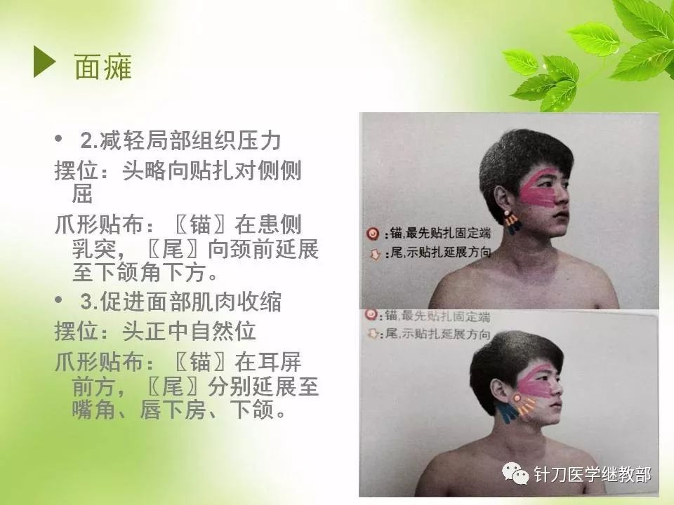 肌内效贴扎技术在康复中的应用
