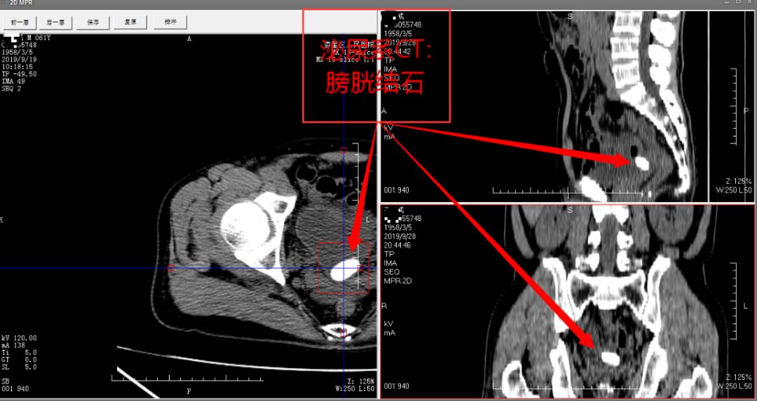 输尿管结石ct图解读图片