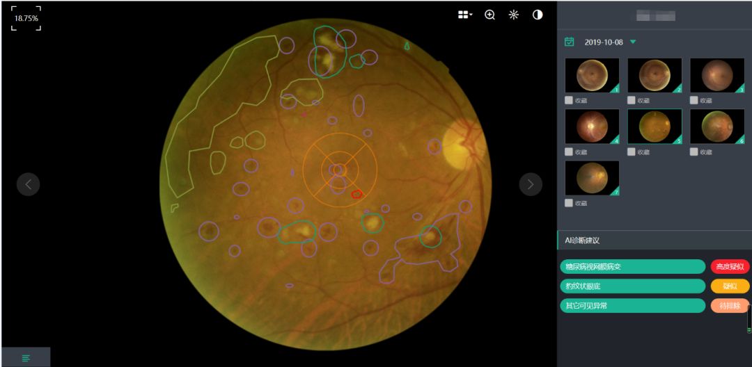 视网膜病变的单一病种;针对多种眼底疾病同时筛查的人工智能自动识别