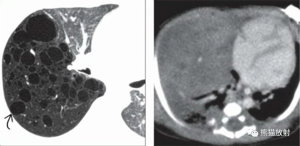 先天性肺气道畸形丨ct表现诊断要点