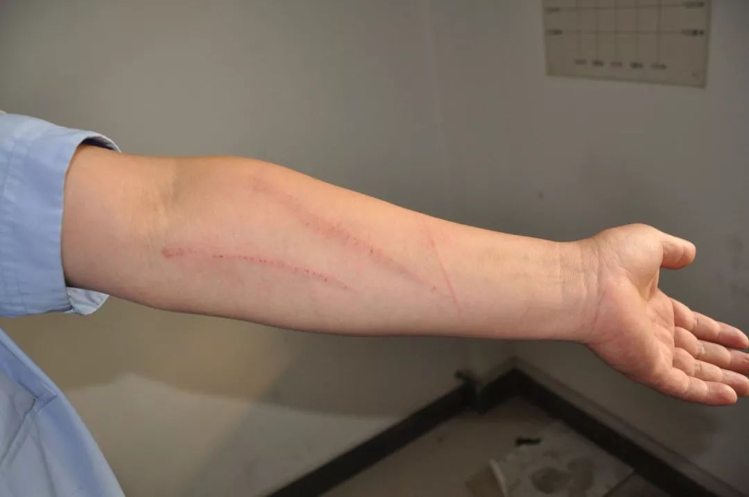 该安庆一男子酒后抓伤民警被行政拘留10日