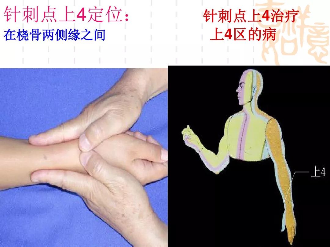 颅骨骨牵引进针点位置图片