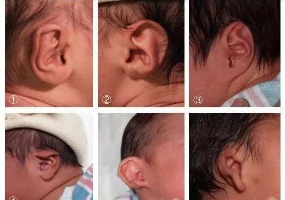 婴儿垂耳长大的图片图片