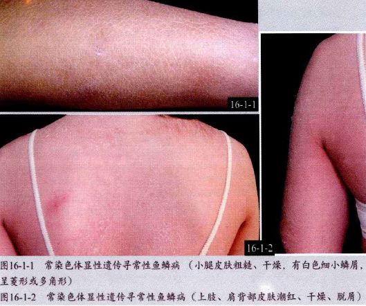脂溢性皮炎74痤疮75酒糟鼻76斑秃77甲病78复方性阿弗他口炎79接触性