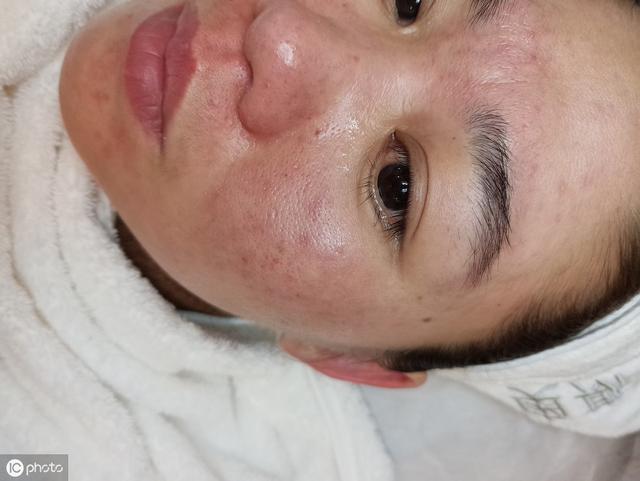 刷酸爆痘期如何度过一定要注意这些