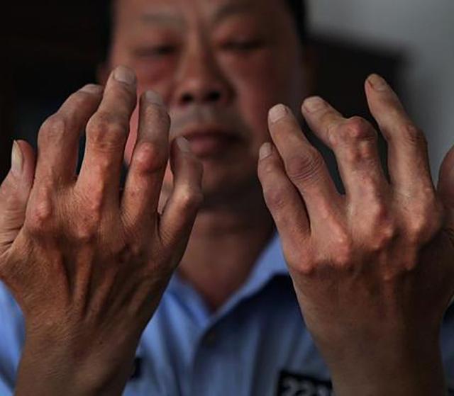 痛风"祸根":除了酒,总往嘴里塞1种食物,尿酸猛飚拦不住