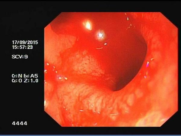 上腹隐痛呕吐伴暗红色液体警惕上消化道出血