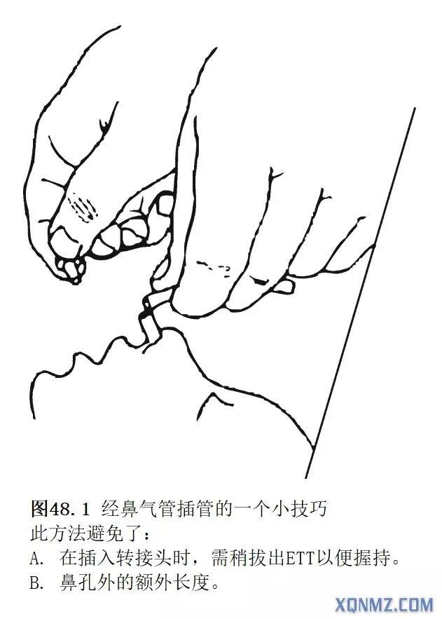 鼻导管的正确戴法图片图片