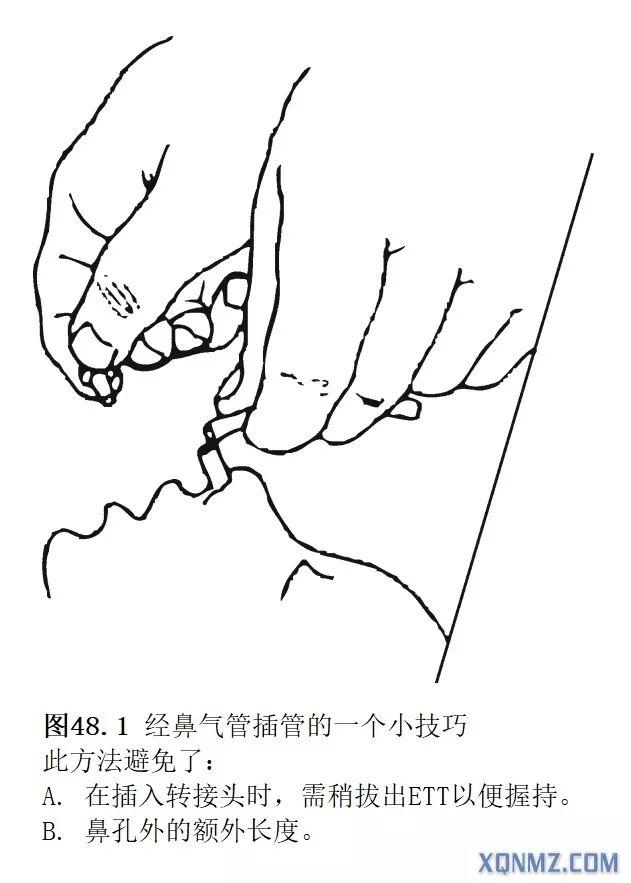 气管插管详细步骤图片