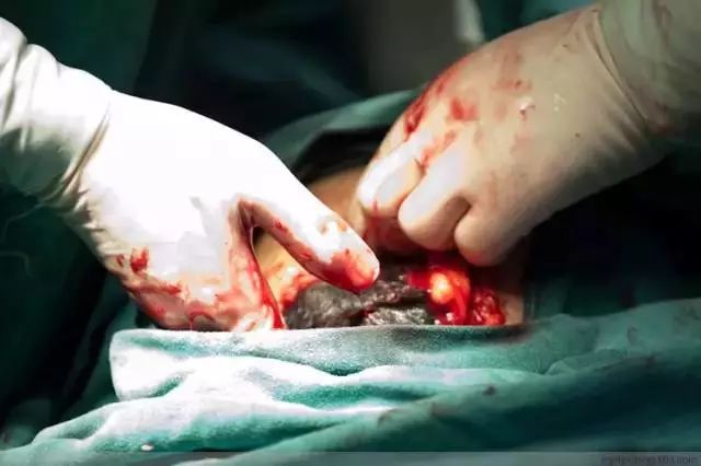 一台手术会用到这么多的剪刀和夹子先用纱布把伤口堵住小心小心再小心