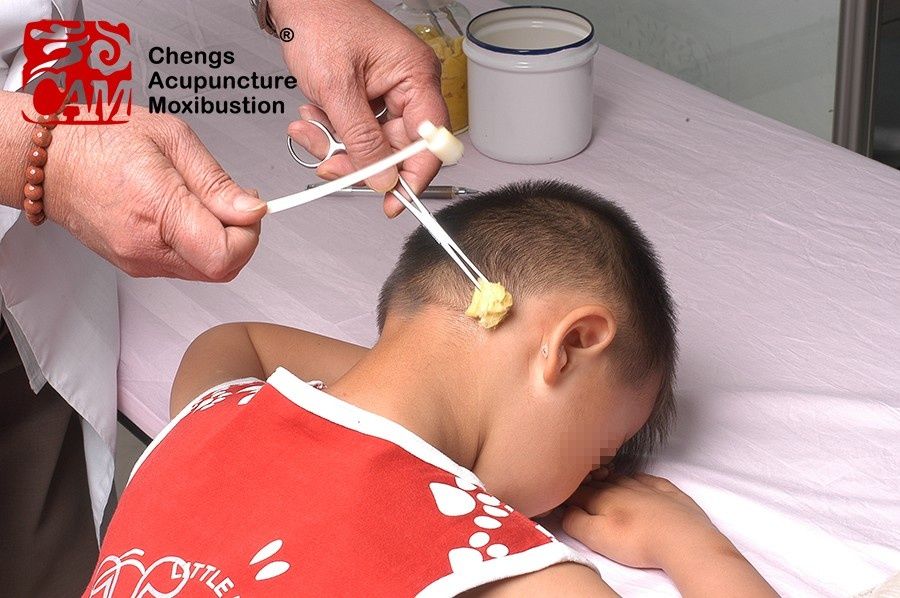 梅花针调节视力