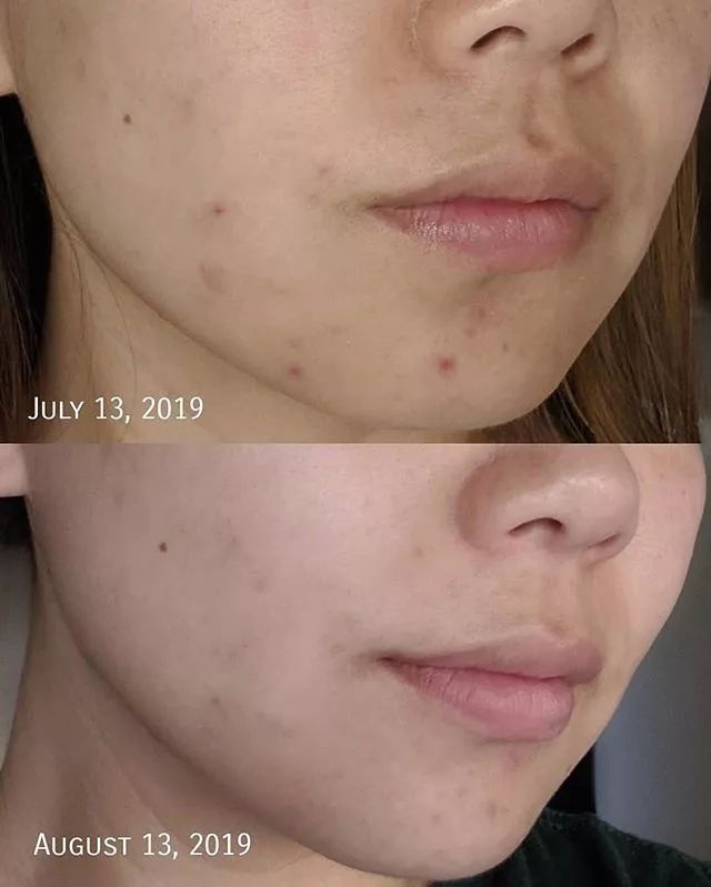 从满脸闭口到最美空姐,李沁对自己的脸做了什么?_水杨酸