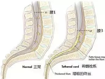 发生了脊髓栓系,患者会出现腰膨大和脊髓,骶髓位置缺血,形成一系列