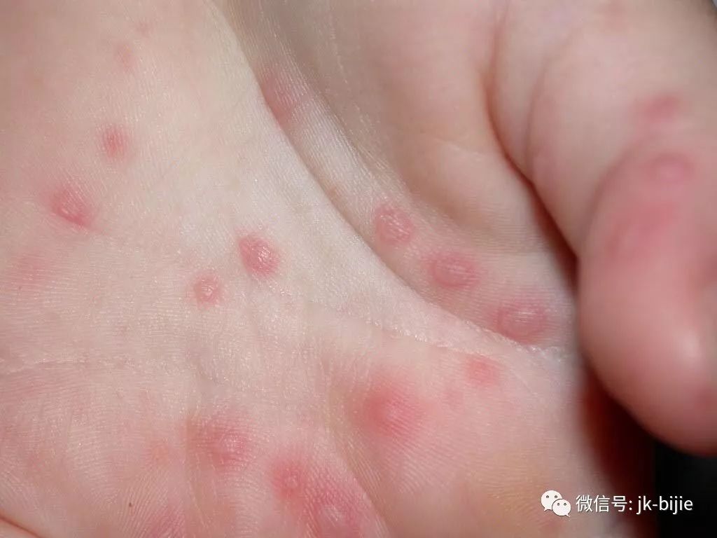 五类儿童常见秋冬季传染病防控信息
