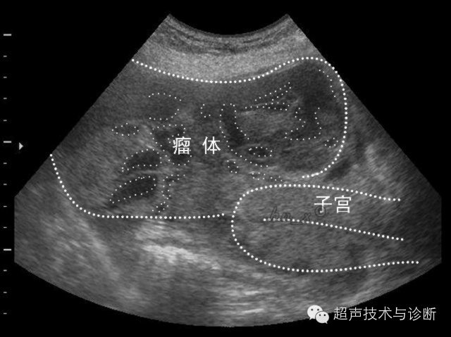 卵巢低分化腺癌聲像圖11-4-11 漿液性囊腺癌彩超表現與血流頻譜圖11-4