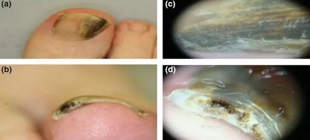 甲下黑素瘤:黑素瘤筛查门诊的经验