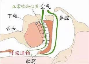 悬雍垂过长是什么原因图片