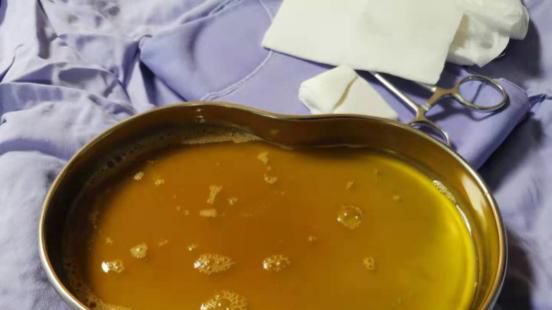 要闻科普北京妇产医院多学科协作及时救助胎粪梗阻性腹膜炎患儿