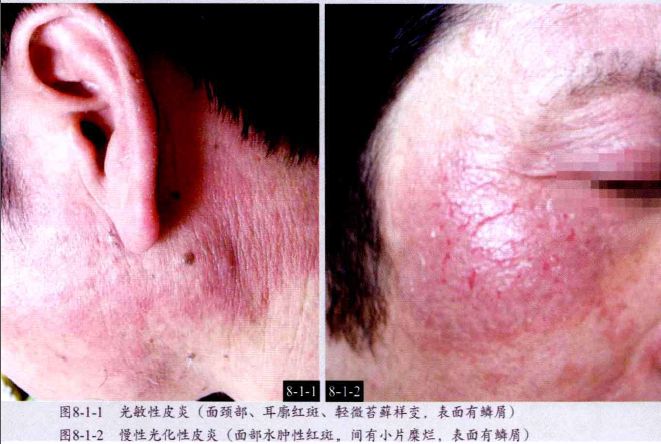 史上最全皮肤病图谱(附治疗方法)_皮炎