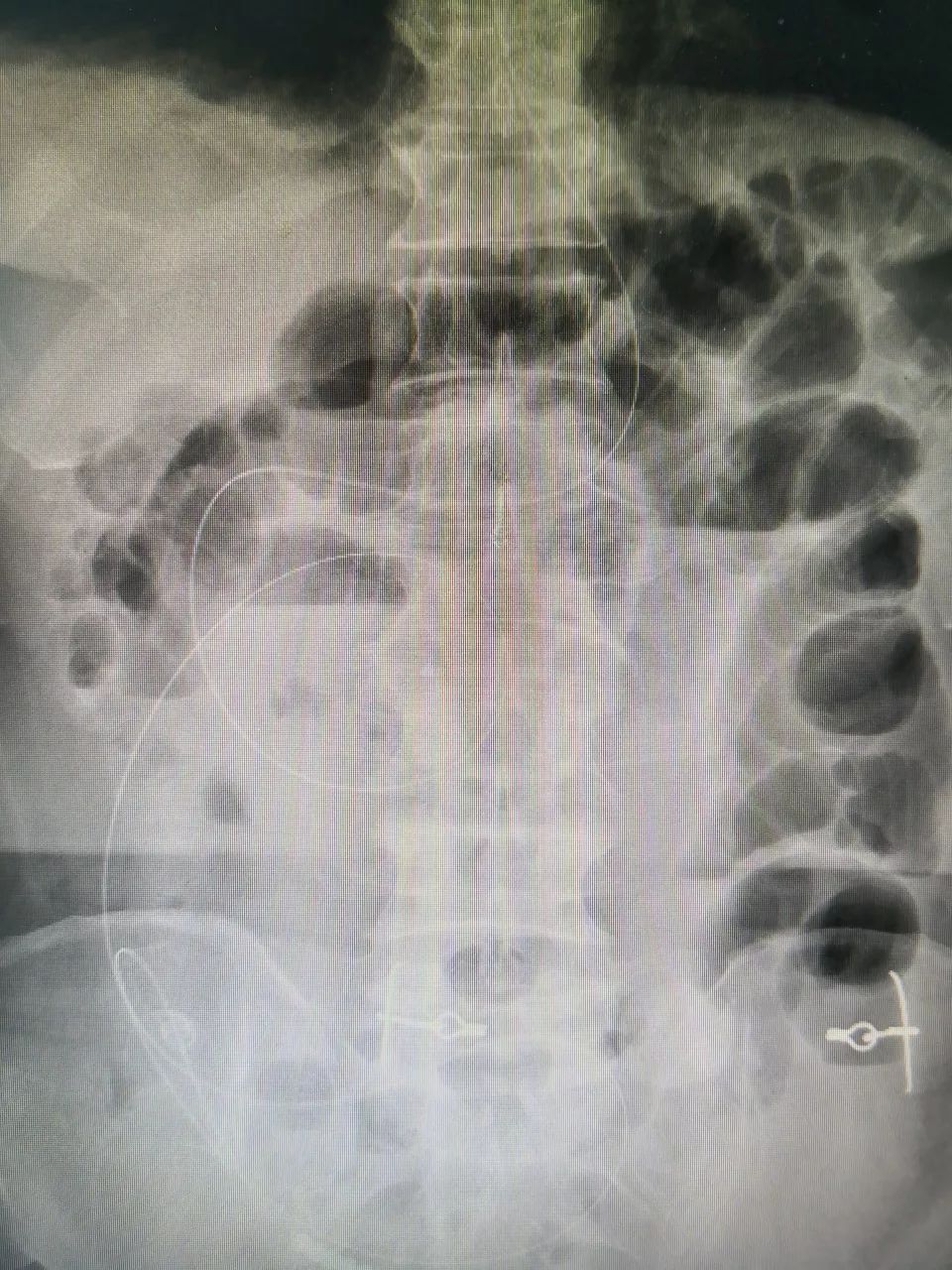 腹部平片肠梗阻图片图片