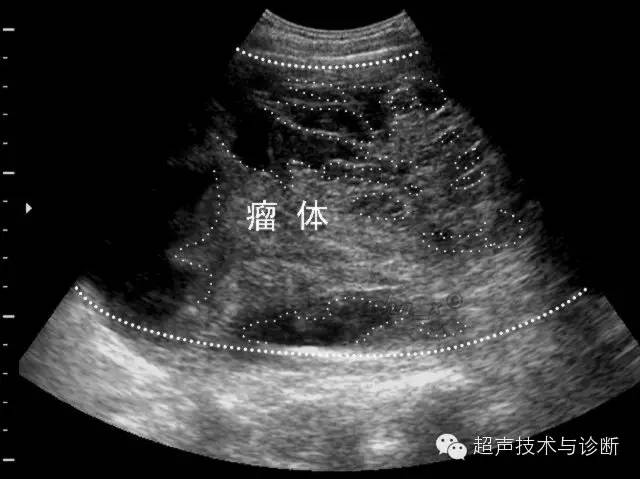 超声微课堂之妇科卵巢恶性肿瘤