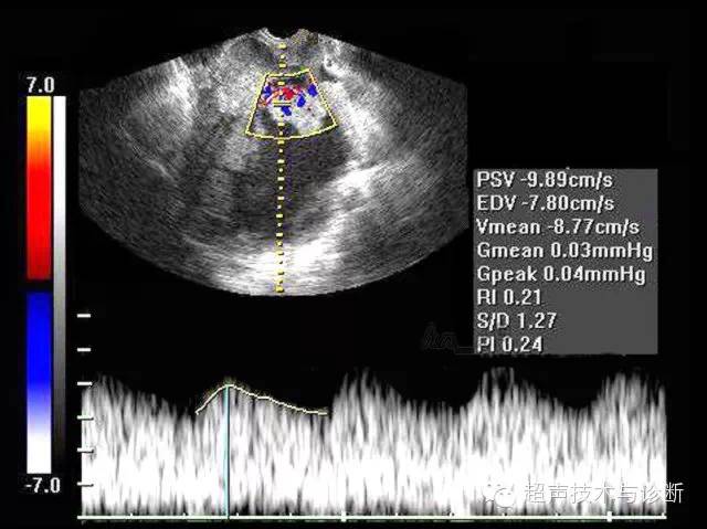 超声微课堂之妇科卵巢恶性肿瘤