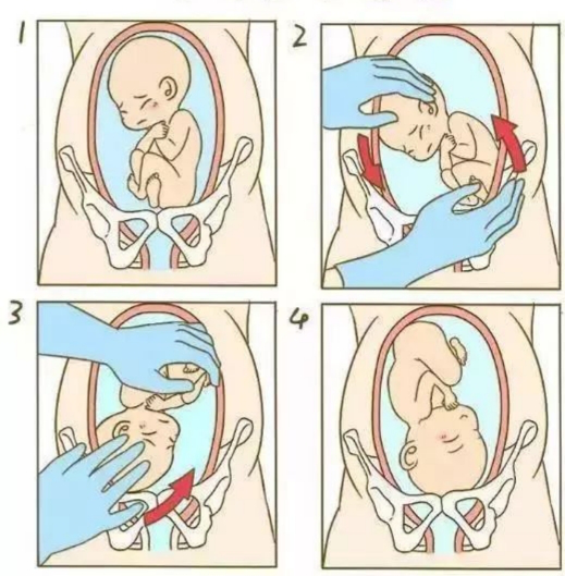 外倒转是经腹壁用手转动胎儿,使不利于分娩的胎位(臀位,横位)转成有