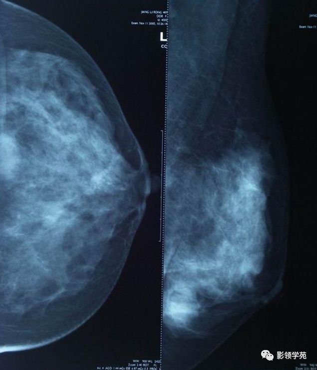 常见乳腺良恶性病变的x线诊断
