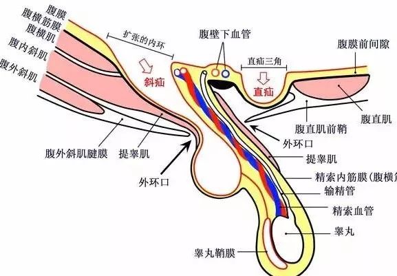 腹股沟疝颈肩部解剖要点(图 1)下降过程中腹横筋膜被鞘状突及输精管