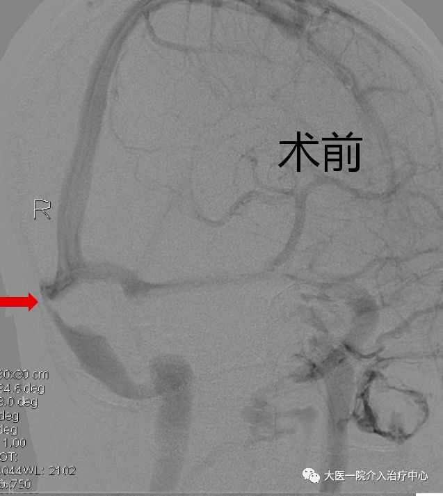 头颅静脉解剖图mrv图片