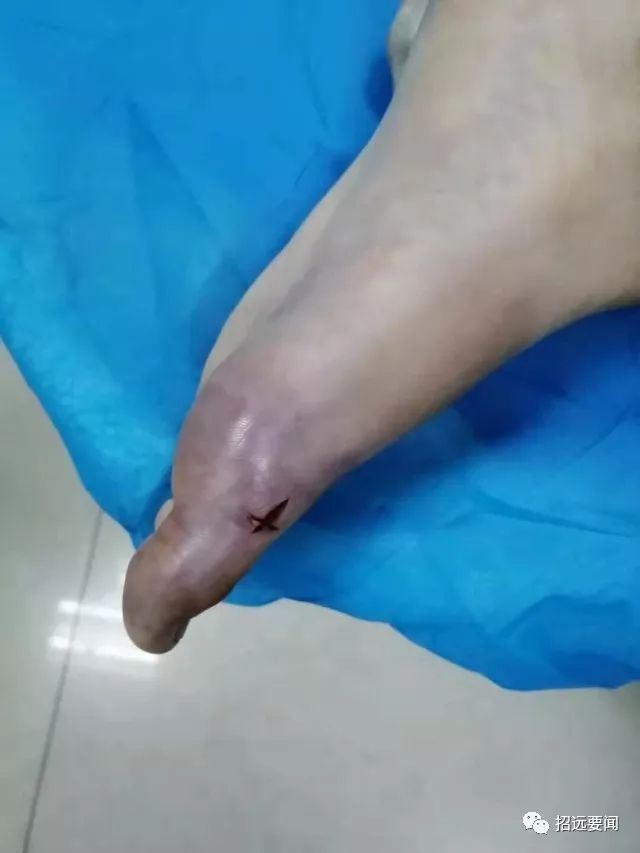 招远英诚医院上演"生死时速"!全力抢救被蛇咬伤患者