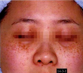 鱼鳞病68毛发角化病69汗孔角化症70掌跖角化病71原发性皮肤淀粉样变性