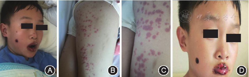 病例报告对乙酰氨基酚引起小儿stevensjohnson综合征一例