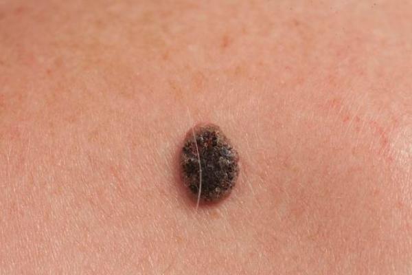 色素痣直接用激光去除就能完全解决问题了吗