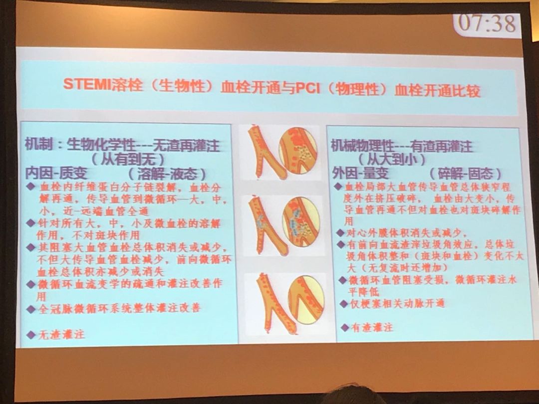 现在对stemi溶栓方法和治疗理念都有了新的认识"无渣"微循环再灌注