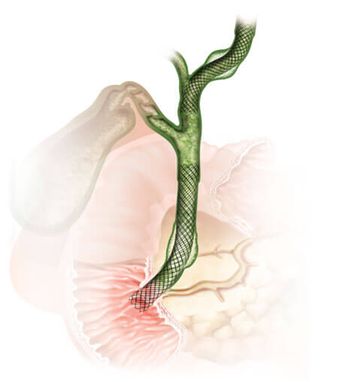 胆管支架图片