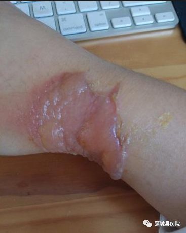 每日健康烧烫伤的急救小常识