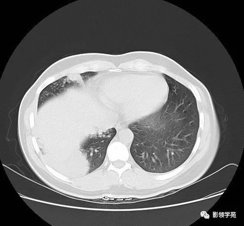 浸润性肺腺癌图片图片