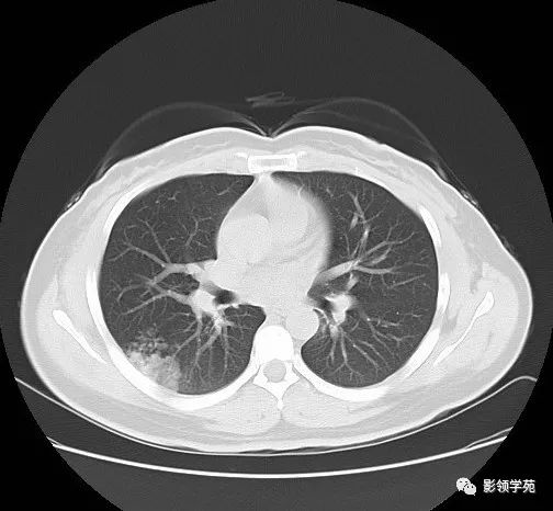 浸润性肺腺癌图片图片