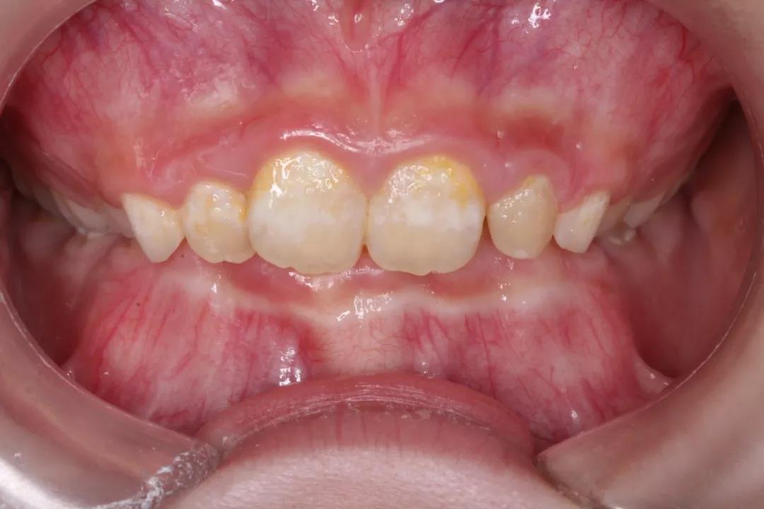 熊孩子再咬嘴唇就得看牙医了