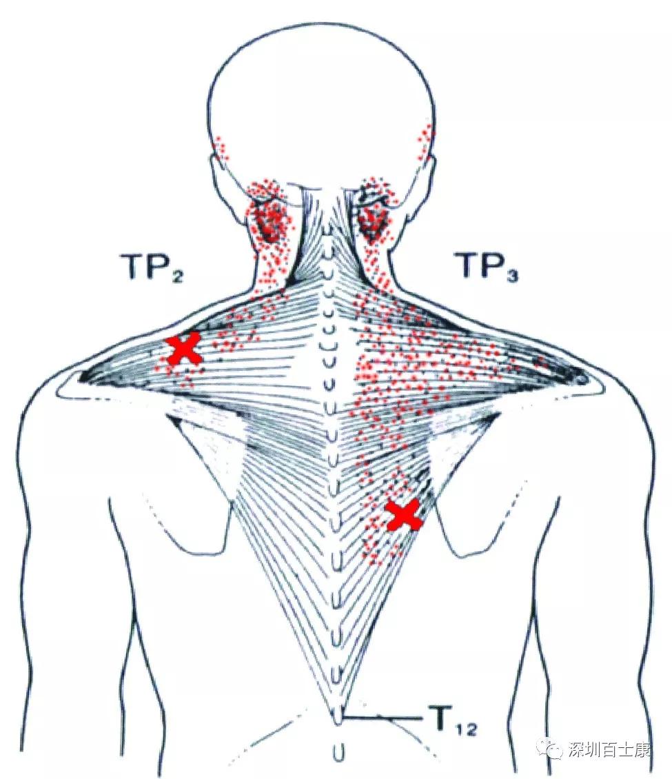 肌肉条索状结节图示图片